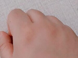 食指 有痣